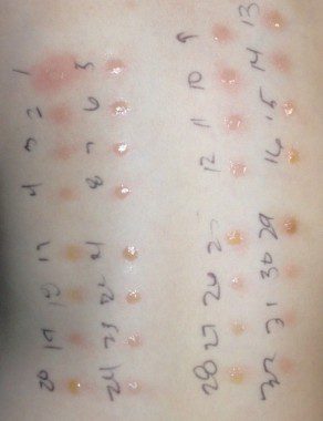 Payton's allergy testing. Ouch, Mama!